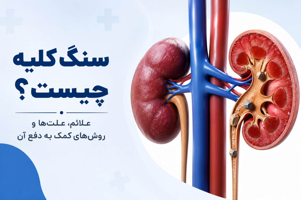 سنگ کلیه چیست؟ علائم، علت‌ها و روش‌های کمک به دفع آن